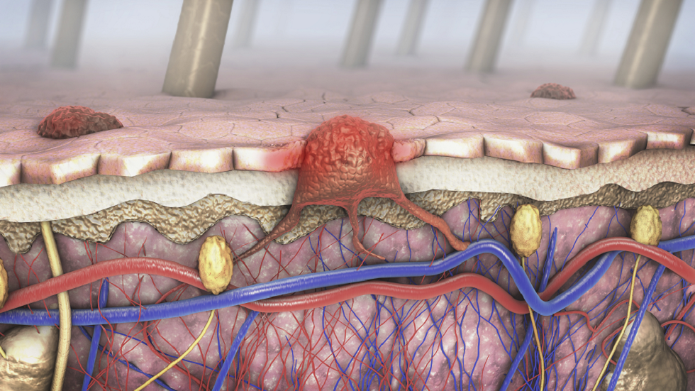 ما علاقة التقدم في العمر بانتشار سرطان الجلد؟