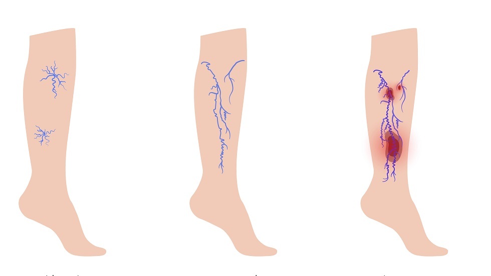 دوالي الساقين.. الأسباب وطرق الوقاية دوالي الساقين.. الأسباب وطرق الوقاية