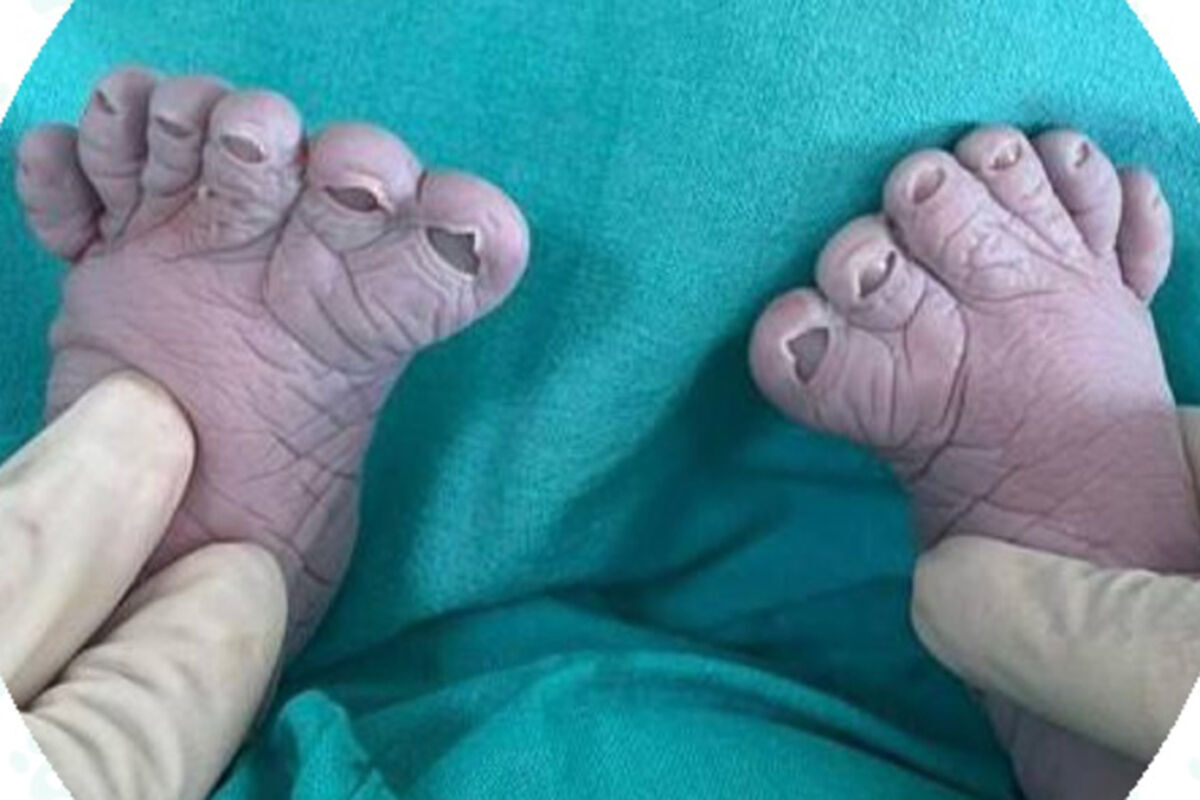سيدة روسية تثير دهشة الأطباء بعدما أنجبت للمرة الثالثة طفلا بـ12 إصبعا في قدميه