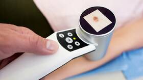 علامات سرطان الجلد 