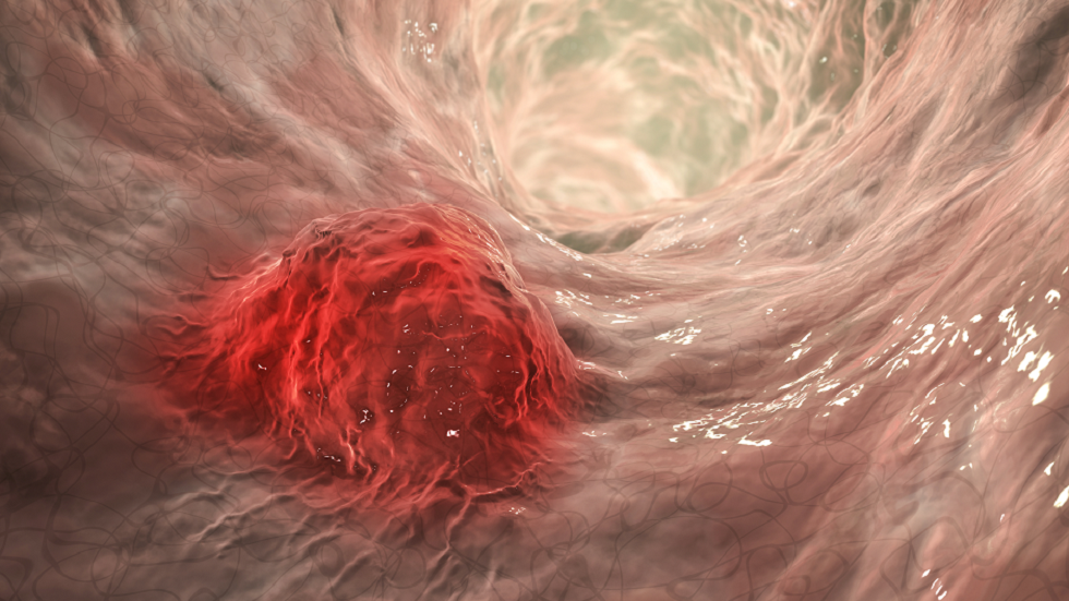 "عقار عجيب" يذيب الأورام السرطانية
