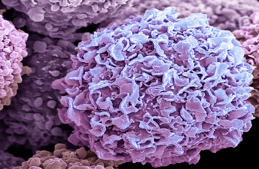 أداة تتنبأ بالآثار الجانبية المرهقة لعلاج شائع لسرطان الثدي