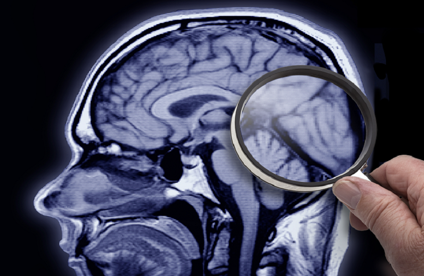 اكتشاف مؤشر مبكر جديد لمرض ألزهايمر