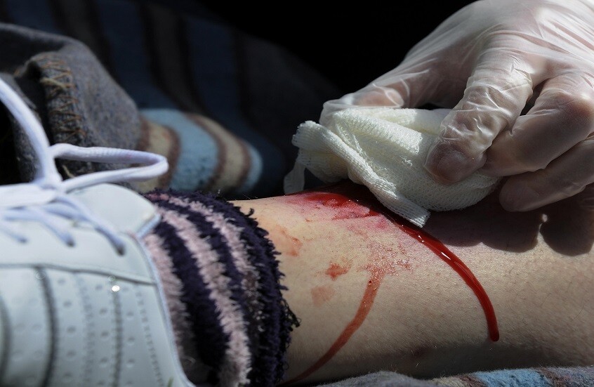 العلماء الروس يبتكرون طريقة جديدة لتسريع التئام الجروح