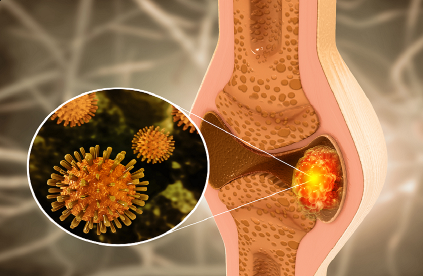 عارض شائع لسرطان العظام لا ينبغي تجاهله أبدا