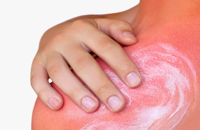 الإسعافات الأولية الضرورية عند التعرض لحروق الشمس