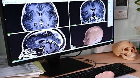 الصحة الاسرائيلية تعلن عن تسجيل إصابة بالتهاب دماغي ناتج عن أميبا نادرة
