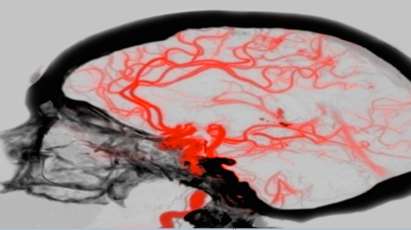 أول أطلس مذهل لمسارات الأوعية الدموية في الدماغ البشري