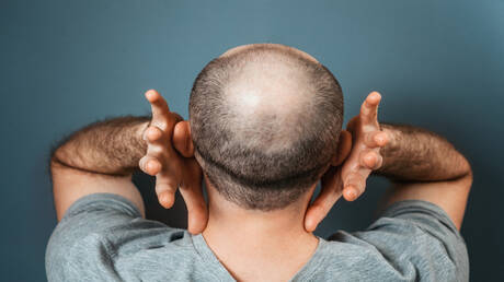 طفرة في علاج الصلع.. سكر طبيعي يحفز إعادة نمو الشعر بشكل كبير