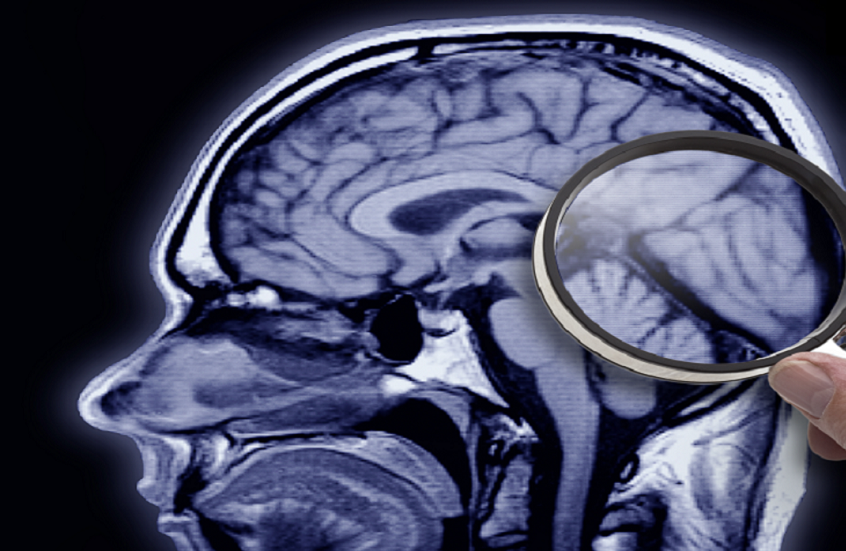 اكتشاف تأثير سحري لـ"الدوبامين" على دماغ مرضى ألزهايمر