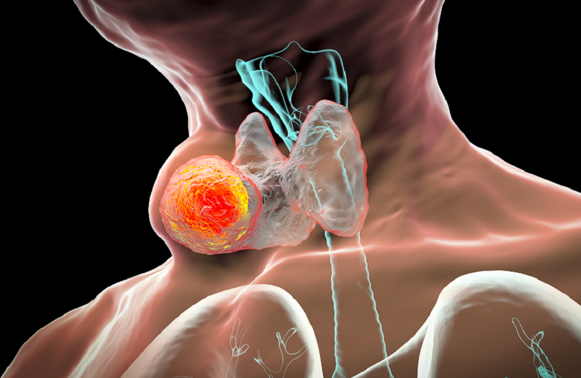 منتج شائع الاستخدام قد يساعد في التنبؤ بعودة الإصابة بالسرطان