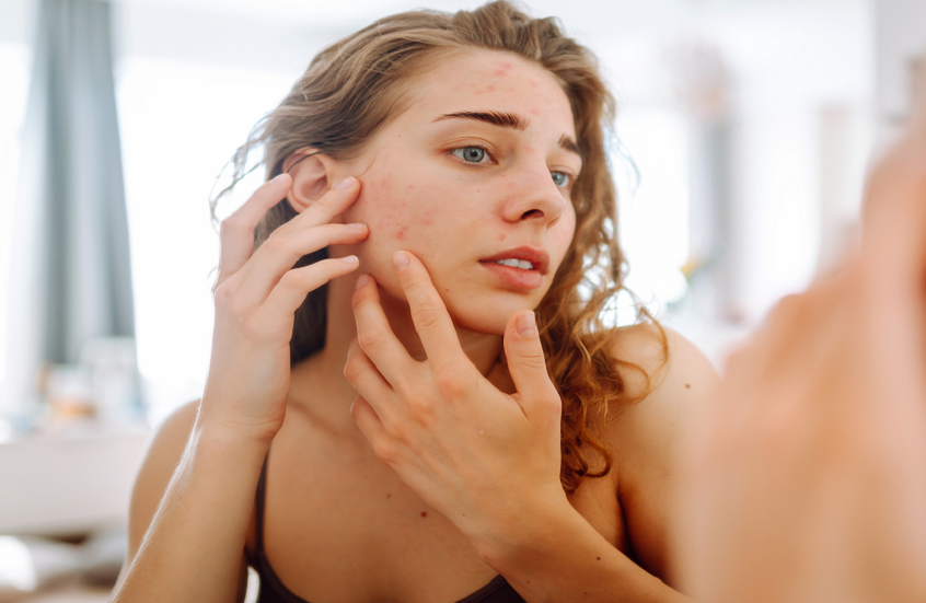 ما خطورة فقع البثور في 