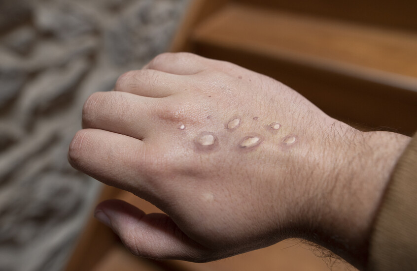 مصر.. عدد حالات جدري القردة المسجلة في البلاد خلال السنوات الماضية