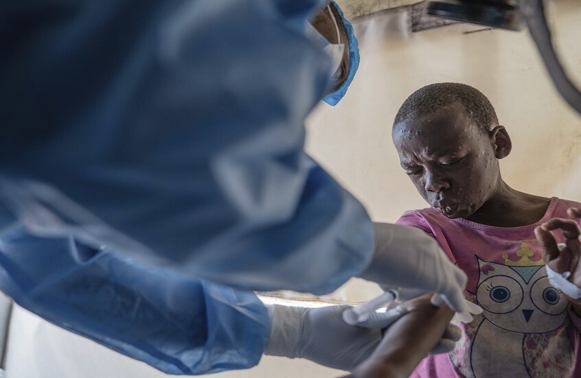 الكونغو تعلن تسجيل أكثر من ألف إصابة جديدة بجدري القرود في أسبوع والسلطات الإفريقية تطلب لقاحات