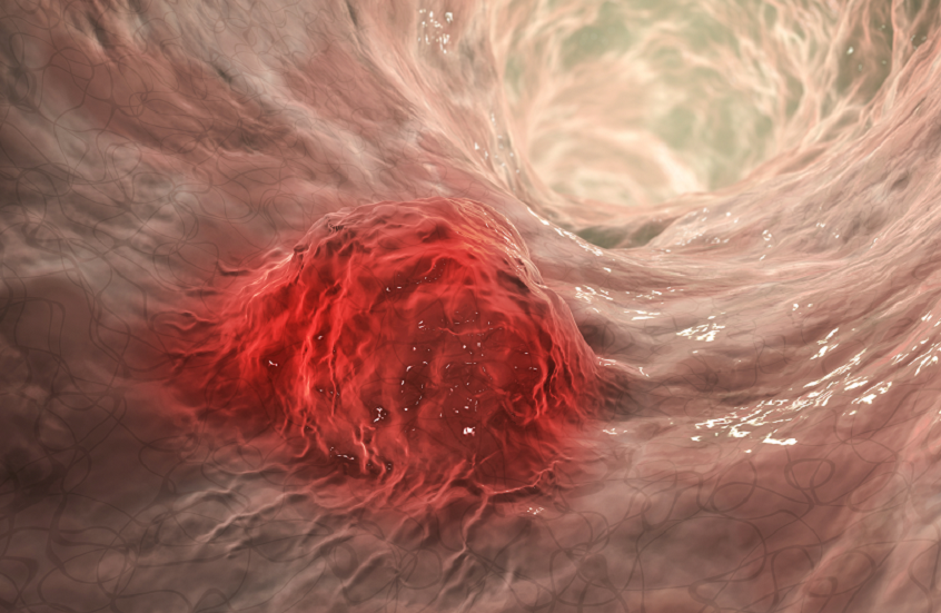 6 نصائح غير تقليدية للوقاية من السرطان