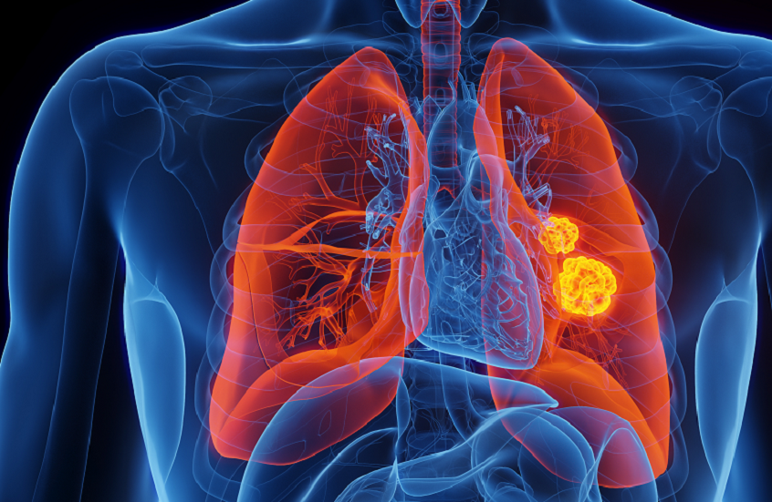 أول مريض في المملكة المتحدة يتلقى لقاحا مبتكرا لسرطان الرئة