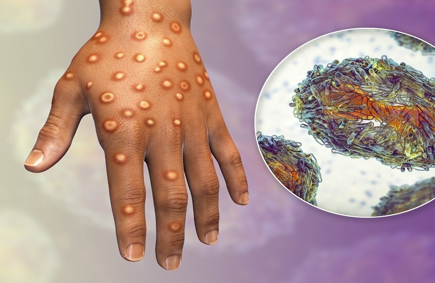 الأردن تعلن تسجيل حالتي إصابة بجدري القرود 