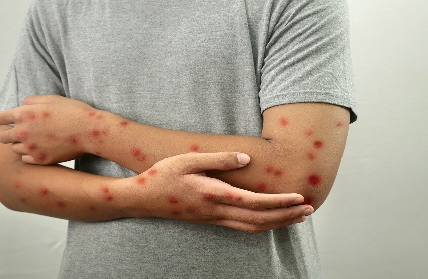 بعد اكتشاف مصاب بجدري القردة.. الأردن يبدأ حملة تقصي مصدر العدوى