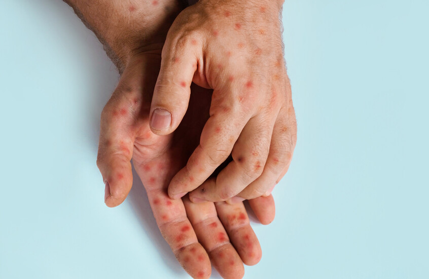 مستشار أوبئة: جدري القردة ليس خطيرا و80% من الحالات تشفى تلقائيا