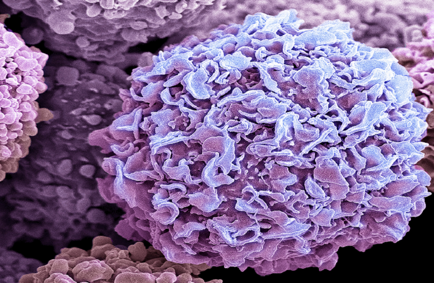 ما علاقة فطريات الجلد بسرطان الثدي؟!