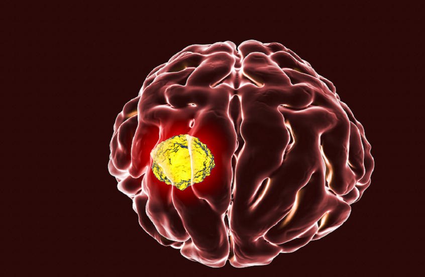 ابتكار علاج جديد لمحاربة أخطر أنواع سرطان الدماغ