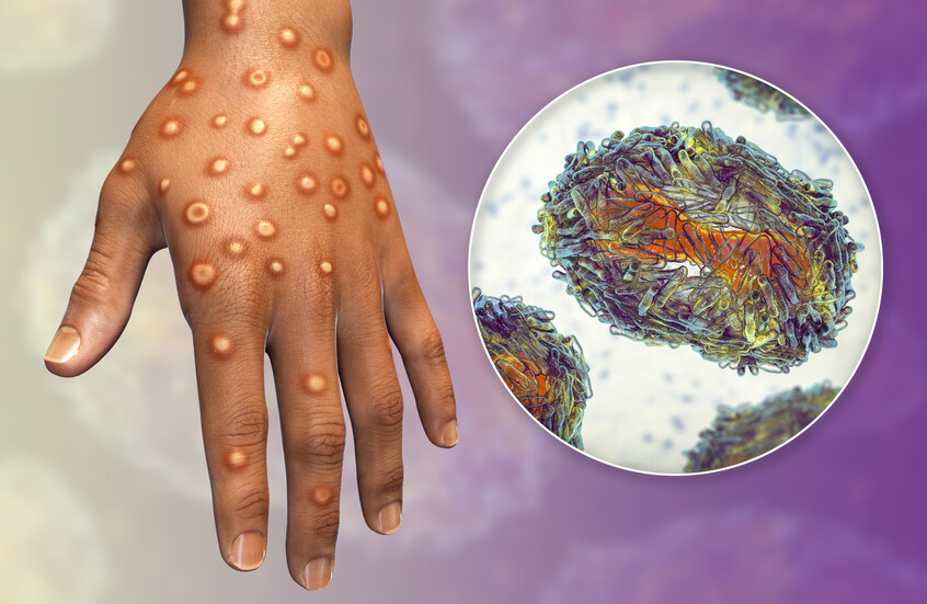 بلد عربي يسجل أول حالة إصابة بمرض "جدري القردة"