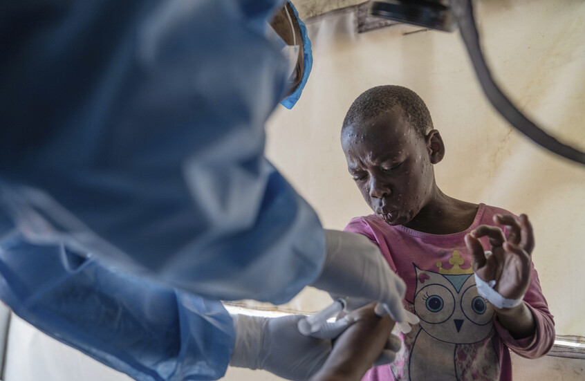 الصحة العالمية تصدر أول موافقة على لقاح "جدري القردة"