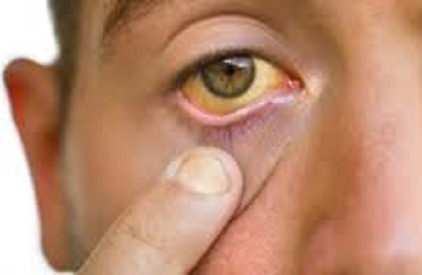 مصر.. بيان عاجل حول إصابات الفيروس الكبدي بالمنوفية