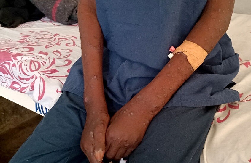 الصحة العالمية: نحو 30 ألف حالة اشتباه إصابة بمرض "جدري القردة" في إفريقيا