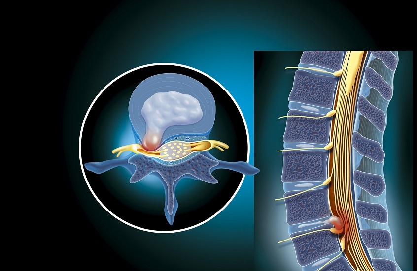 دواء جديد يعطي الأمل لمرضى الانزلاق الغضروفي