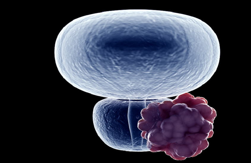 اختبار دم يتنبأ بفترة بقاء مرضى سرطان البروستات على قيد الحياة!