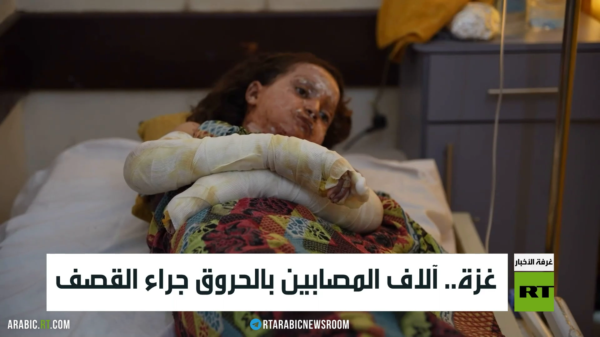 غزة.. آلاف المصابين بالحروق جراء القصف