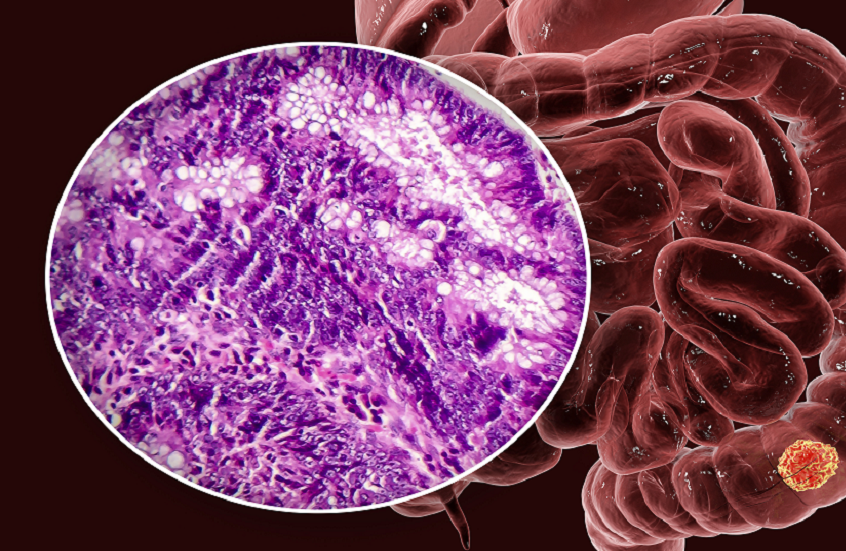 تفشي سرطان القولون بين الشباب.. هل تلعب حقن إنقاص الوزن دورا في مكافحته؟