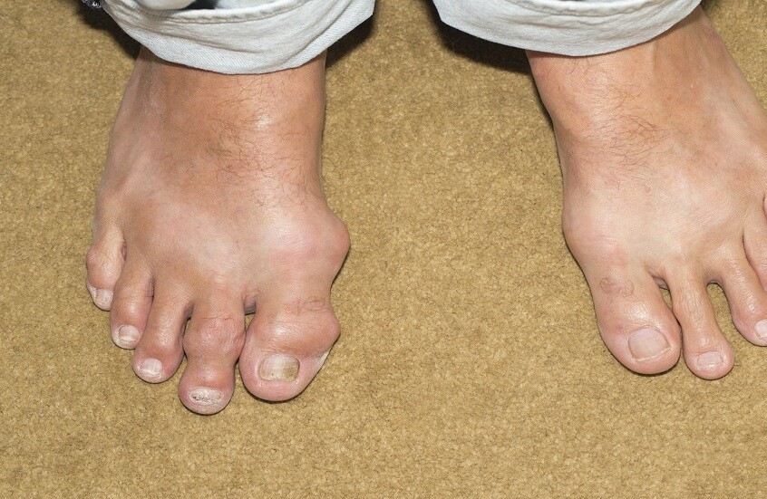 الأطعمة والمشروبات المسببة لمرض النقرس