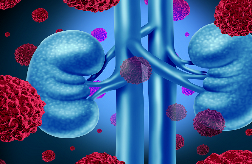 الزرنيخ في المياه الجوفية.. خطر غير مرئي يزيد من حالات سرطان الكلى