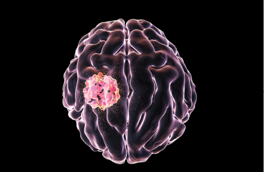 عقار شائع لضغط الدم يظهر تأثيرات واعدة ضد ورم دماغي نادر