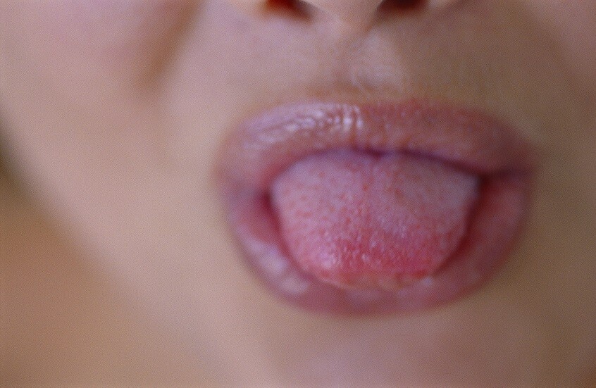 إلى ماذا يشير لون اللسان؟