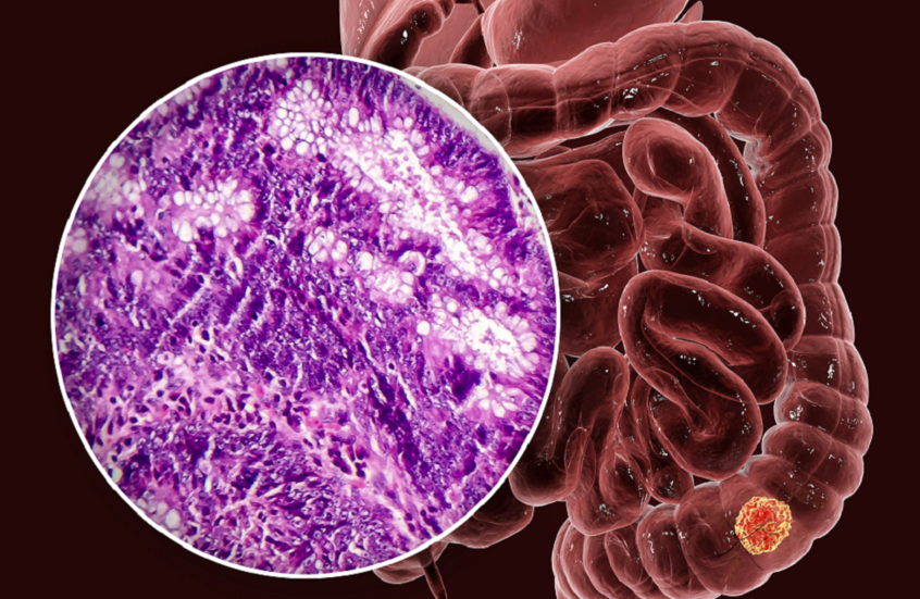 دراسة إماراتية تكشف عن "سلاح فعّال" ضد أحد أنواع السرطان