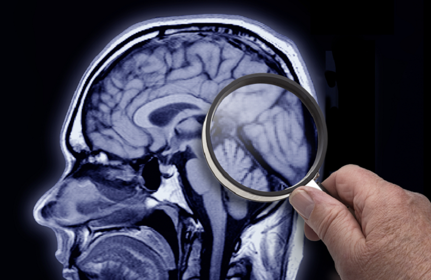 اختبار جديد يتنبأ بمرض ألزهايمر قبل ظهور الأعراض