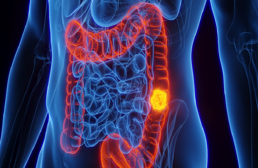 غذاء قد يقلل خطر نوع معين من سرطان الأمعاء