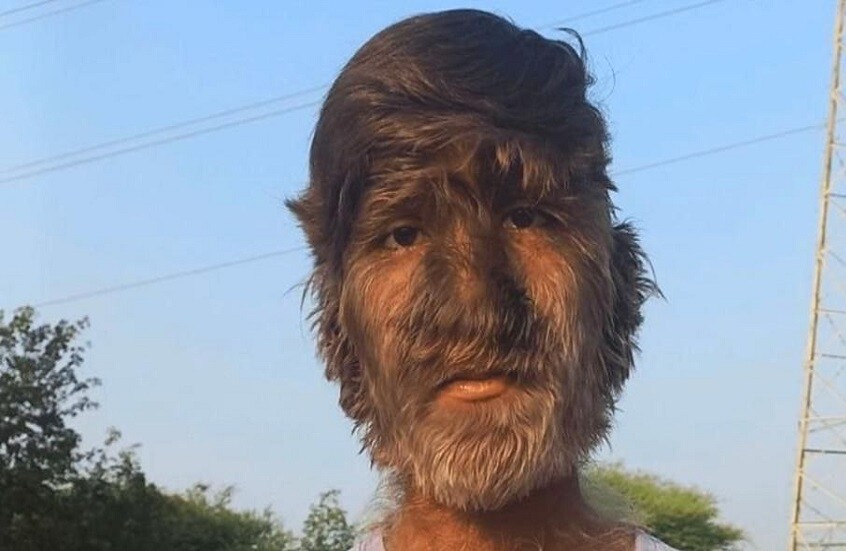 فتى هندي يدخل موسوعة غينيس بسبب كثافة شعر وجهه (فيديو)