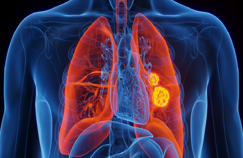"مصاصة عملاقة تغذي السرطان".. مفتاح جديد لفهم علاقة التغذية بسرطان الرئة