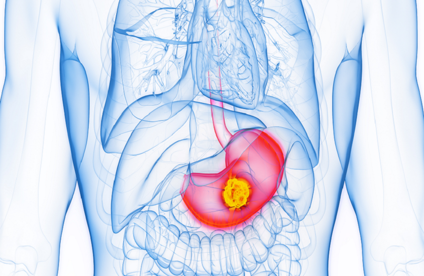 الكشف عن المراحل المبكرة وسبب جديد محتمل لسرطان المعدة