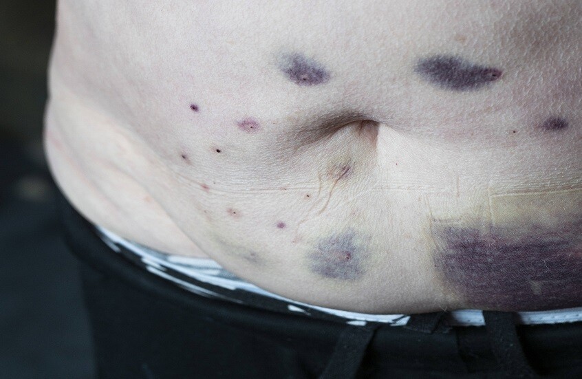 كدمات على الجسم لا ينبغي تجاهلها