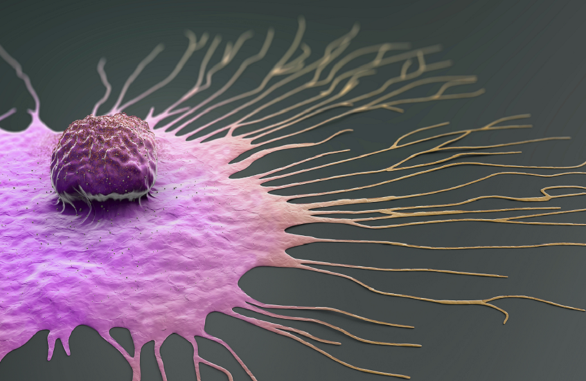 مكون غذائي شائع يعزز نمو نوع عدواني من سرطان الثدي