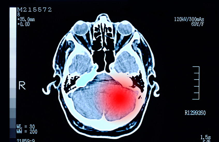 "سر الطابق الخامس".. 6 إصابات غامضة بأورام دماغية بين موظفي مستشفى أمريكي تثير الذعر