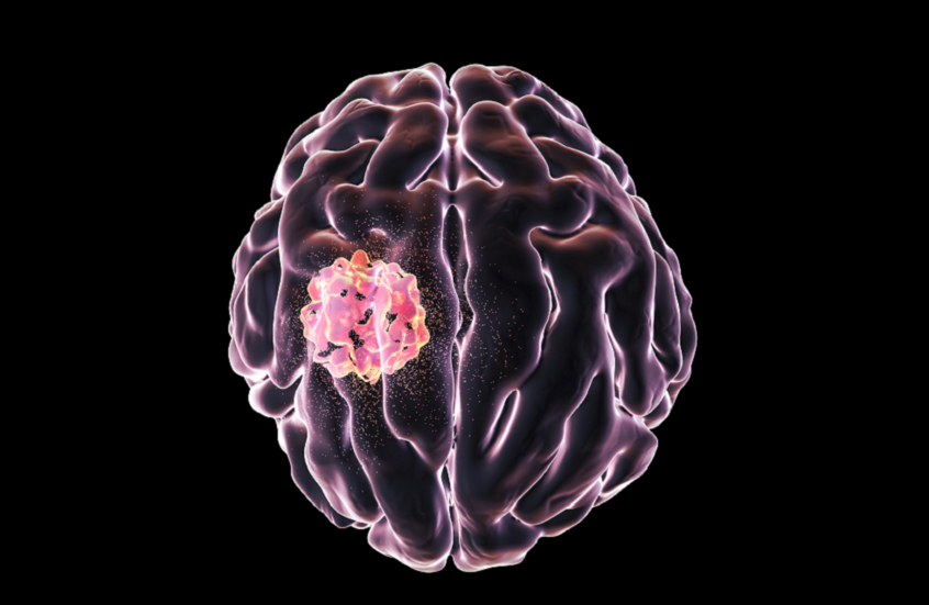 تحديد هدف علاجي جديد لسرطان دماغي عدواني