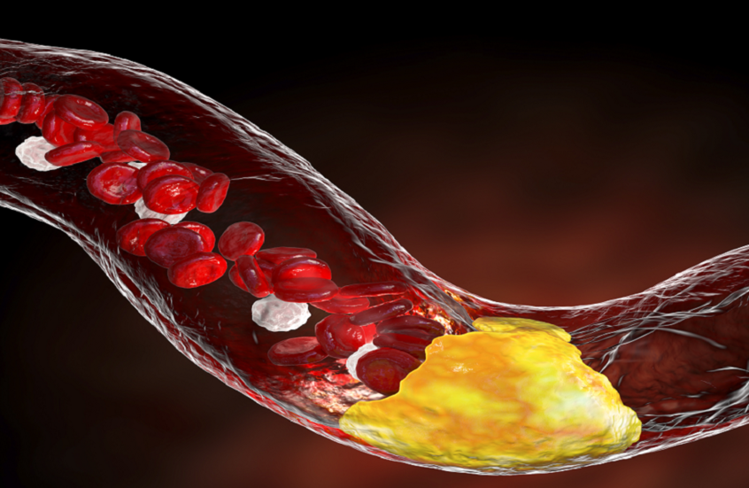 خرافة الكوليسترول.. هل حقا هو العدو الأول للقلب؟