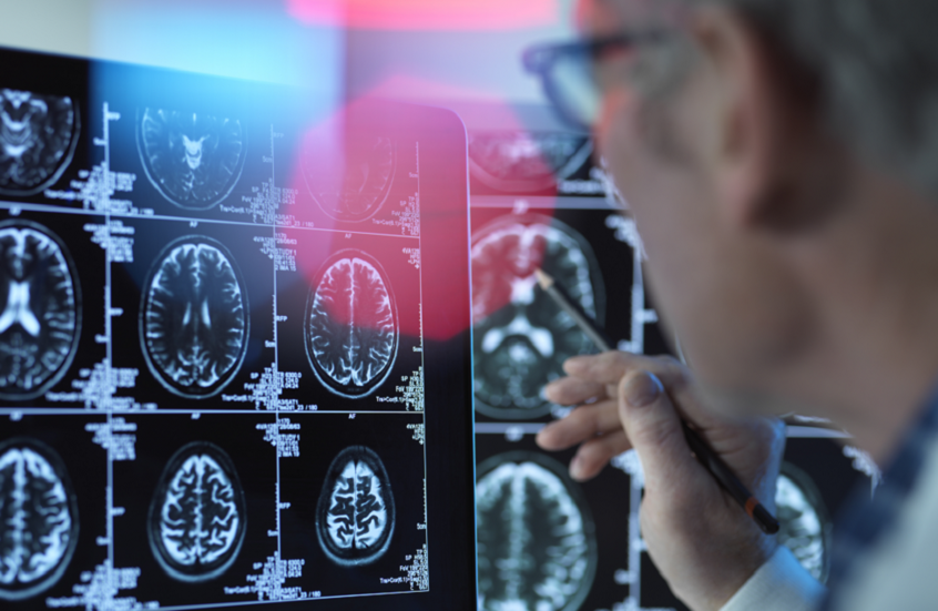 فيروس شائع الانتشار يزيد احتمال الخرف المبكر!