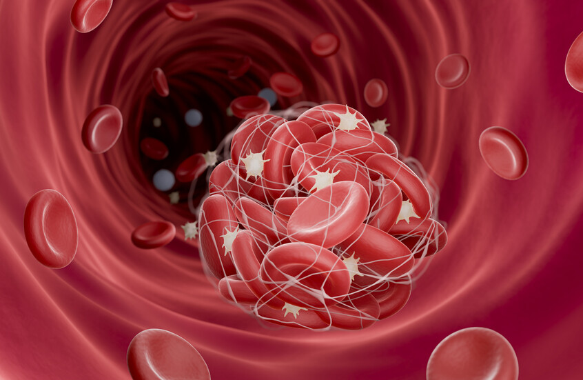 "خطر صامت" يتسلل إلى الشرايين ويهددنا بجلطات قاتلة